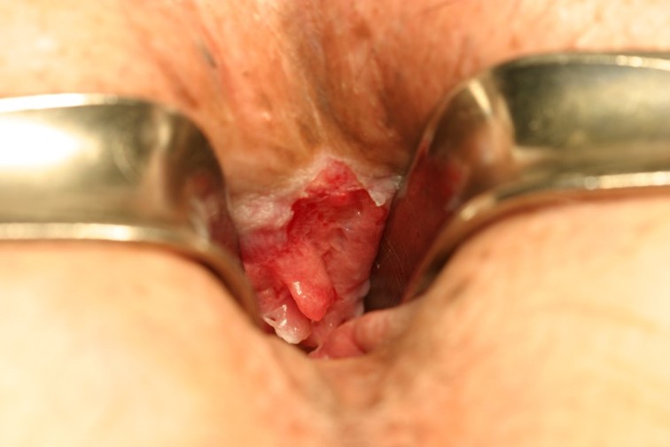肛門狭窄の治療フロー1